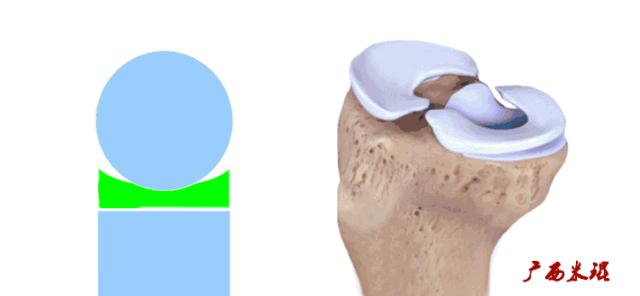 有关半月板的疾病与治疗,听骨科医生讲的话