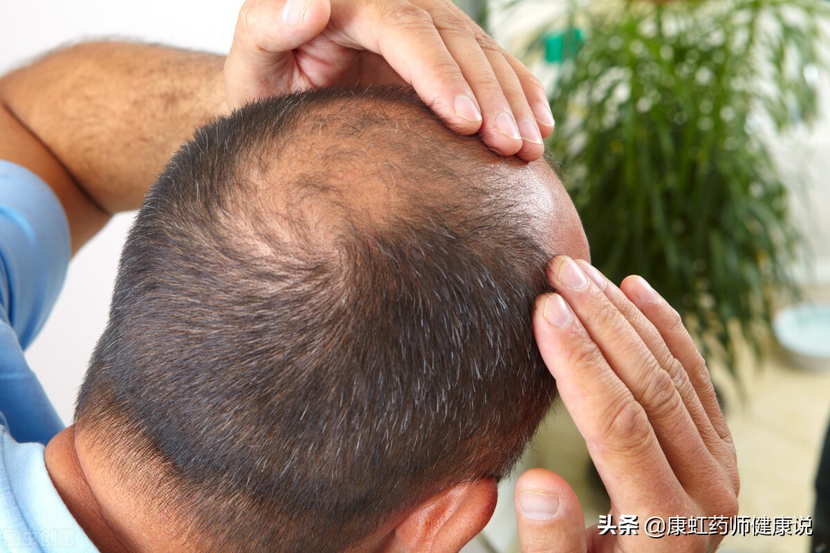 脱发必须吃非那雄胺和米诺地尔吗,脱发吃非那雄胺需要监测雌激素吗