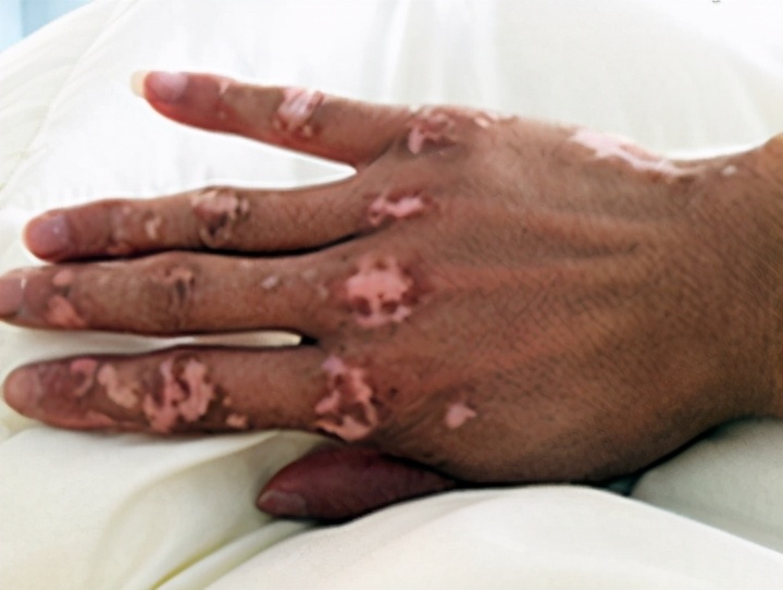 冻疮引起的白癜风会扩散吗,白癜风导致冻疮怎么治