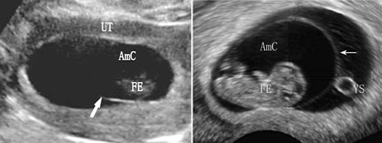 妇科超声和早孕超声有什么区别,明明白白做b超