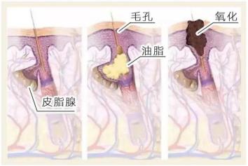 鼻子黑头怎么彻底解决,鼻子黑头最简单的消除方法