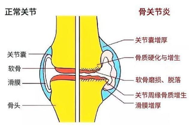 关节封闭针怎么打,关节疼打封闭针视频