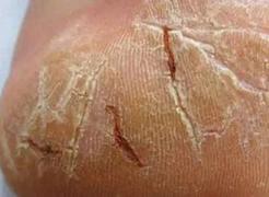 手足护理保湿方法,手足护理防干燥脱皮干裂