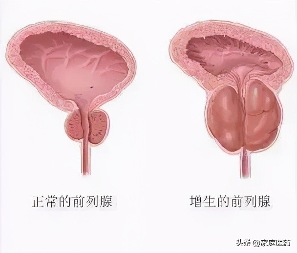 我国前列腺增生发病率逐年增高,原因在这