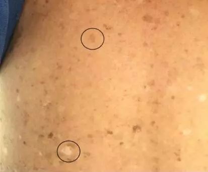 地方病氟中毒宣传,地方病砷中毒特异性症状