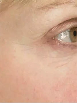 有眼纹了怎么办,30岁有眼袋眼纹很显老的感觉