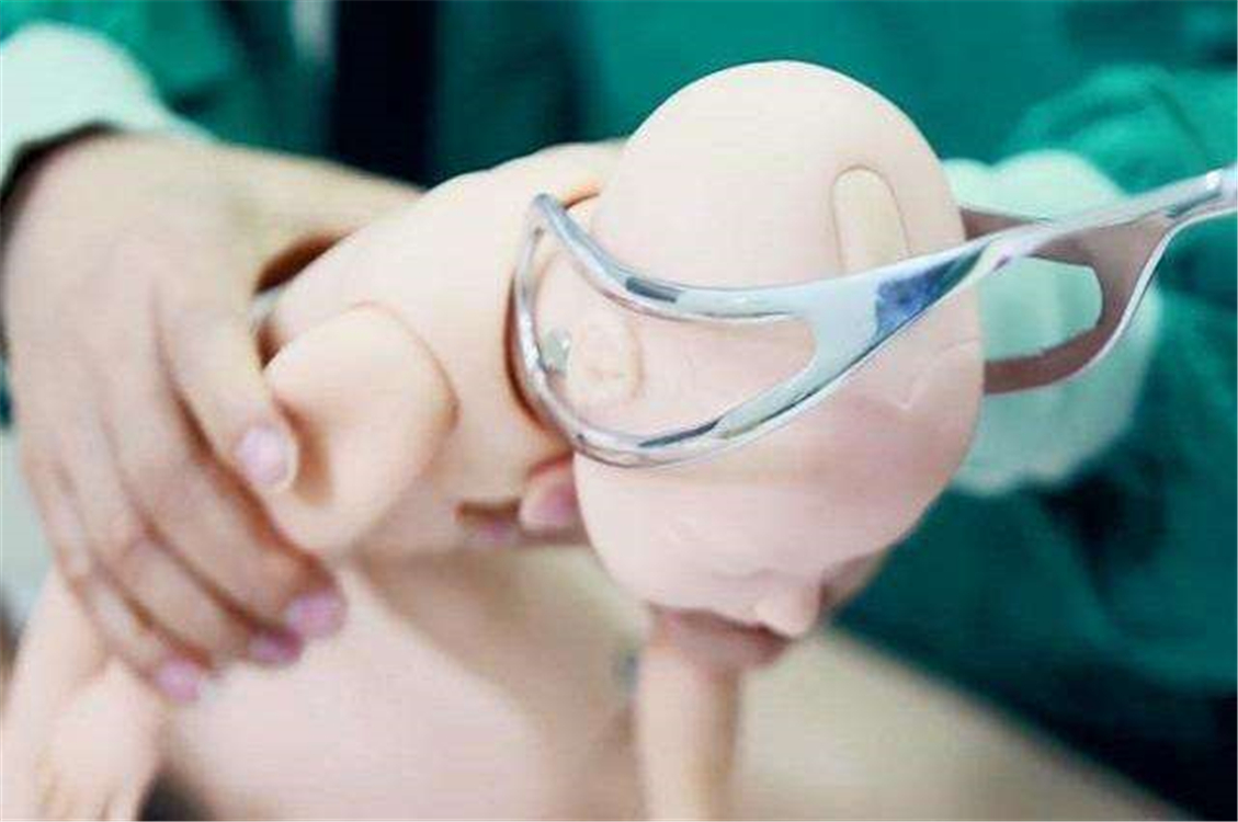 孩子产钳印多久消失,宝宝产钳印怎么消除