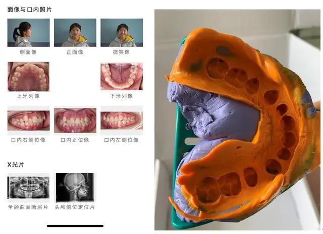 有没有办法把长歪的牙齿矫正,成年牙齿歪了怎么矫正大概要多久