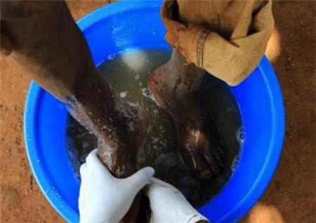 非洲有一种“寄生虫”,能钻到人脚底,小伙脚底被钻出很多个洞