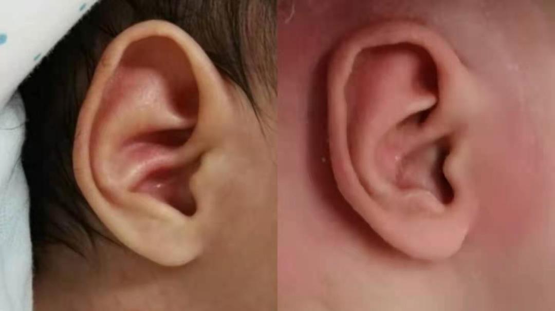 新生儿耳廓畸形需要抹什么药定型,新生儿耳朵轮廓畸形家长怎么办