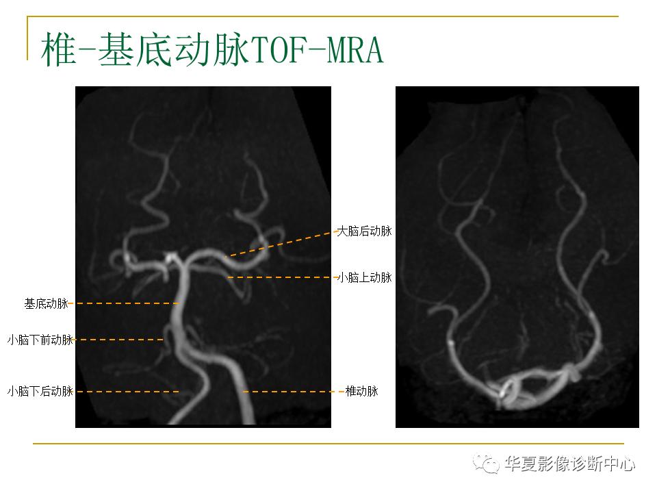 中国人脑立体定向mri应用解剖图谱,脑mri示意图
