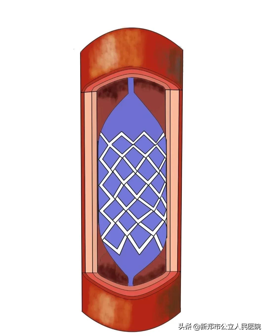 冠脉造影科普宣讲,冠脉CT血管造影