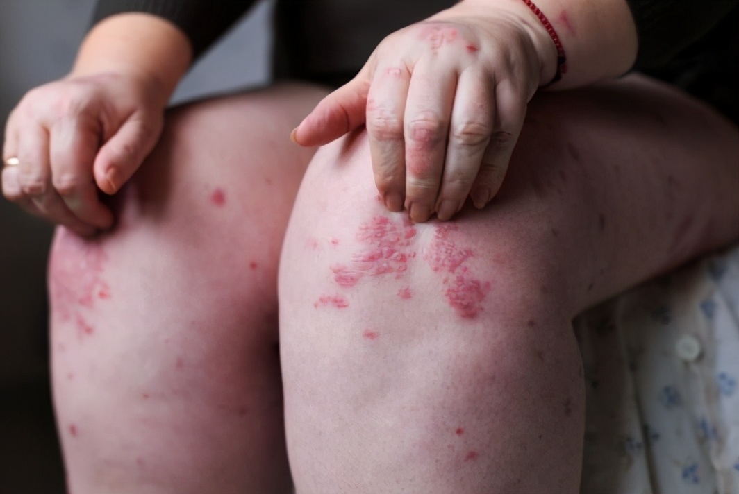 银屑病新药可善挺,牛皮癣新药可善挺