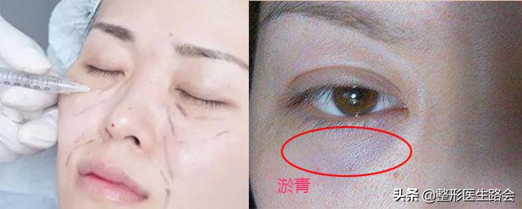 泪沟显老还是泪沟显老,泪沟填充胶原蛋白感觉不好怎么办