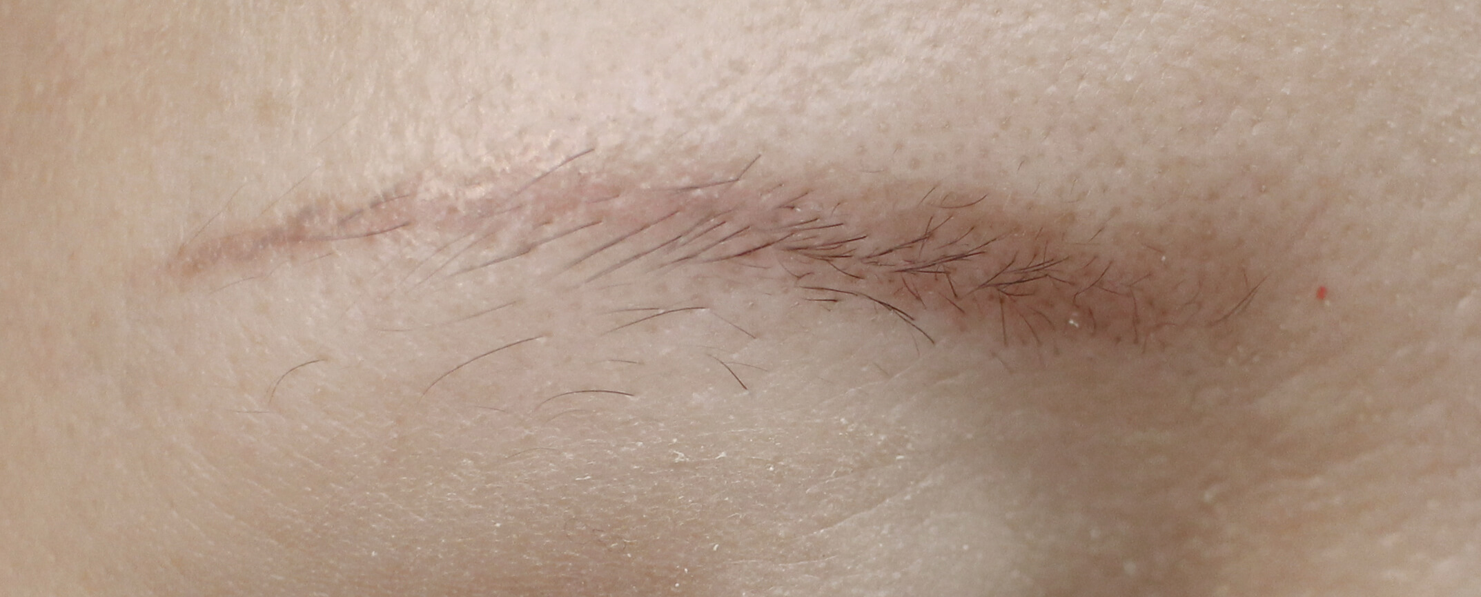 激光洗红眉的操作方法视频,红眉能激光吗