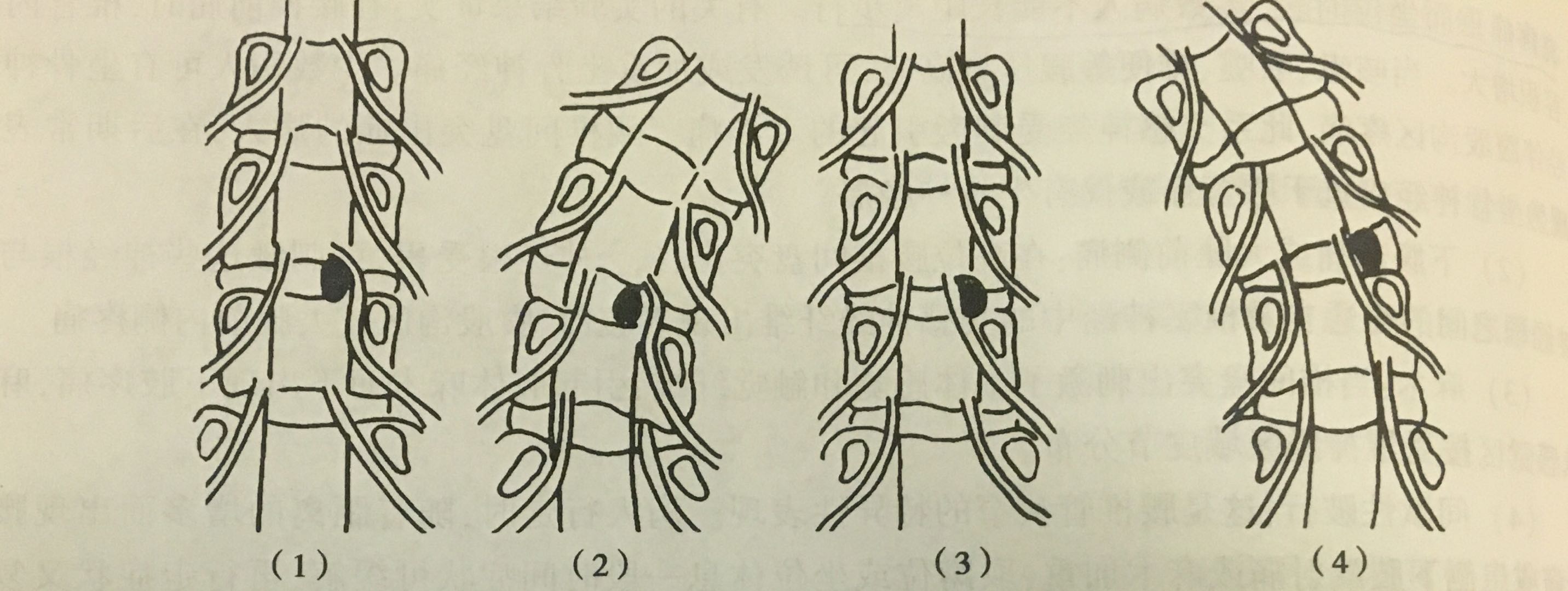 治疗腰椎间盘突出的方法与思路,腰椎间盘突出腰腿酸痛多久能好