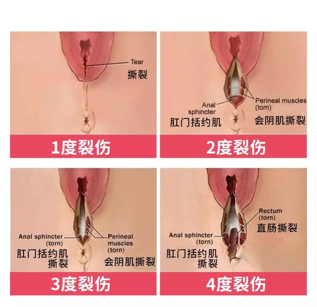 顺产侧切伤口和剖腹产哪个好得快,顺产侧切和剖宫产有什么区别