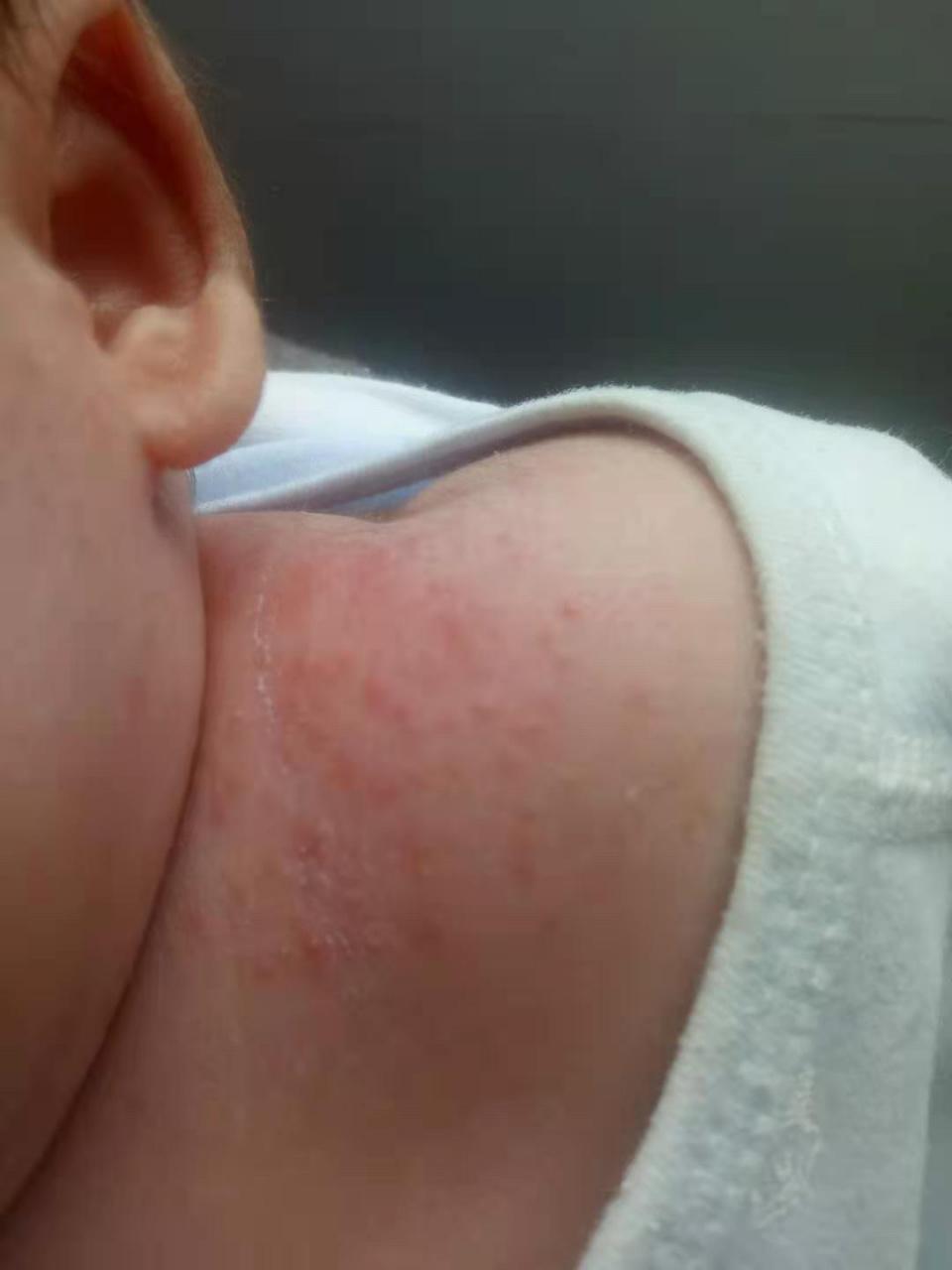 宝宝湿疹严重反反复复怎么办,宝宝湿疹反反复复怎么处理啊