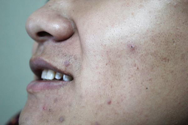 为什么会长痘痘痔疮,为什么会长痘痘还疼