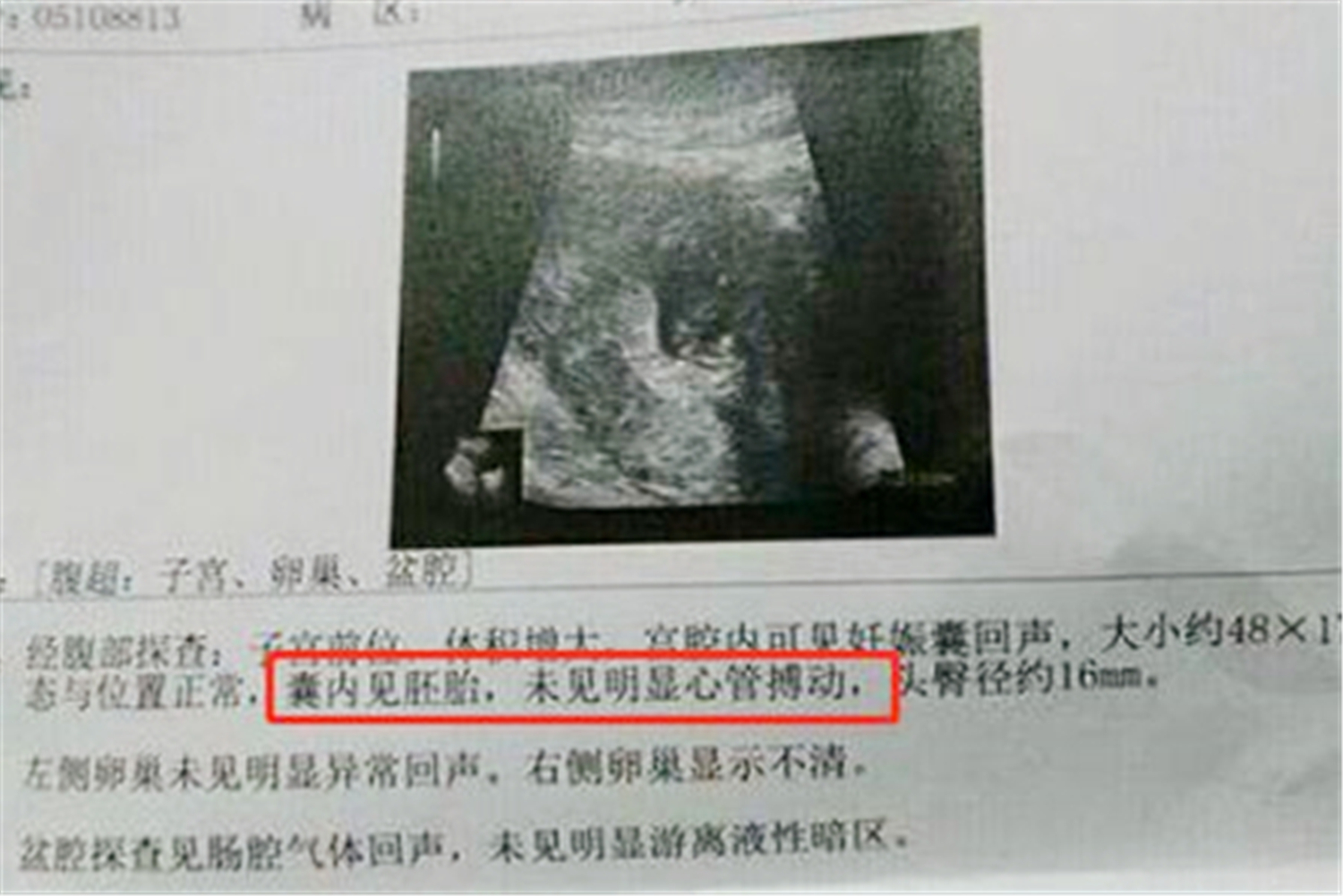 怀孕8周是不是看不出来双胎,怀孕8周还没有看到胎芽正常吗