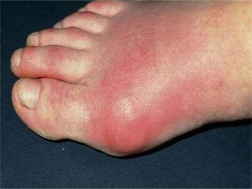 尿酸高一开始会不会脚底痛,尿酸高会一个脚趾痛