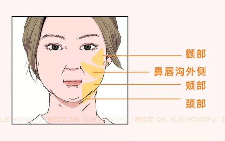 面部吸脂可以瘦脸,面部吸脂全脸什么部位不能吸