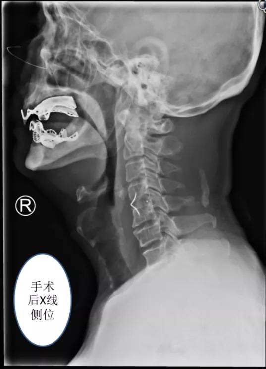 青岛62岁大爷咽不下饭，竟是颈椎骨上长了个“鸟嘴”