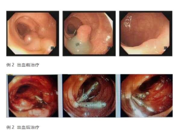 肠息肉切除夹子掉了会出血吗,肠息肉手术夹子脱落会出血吗