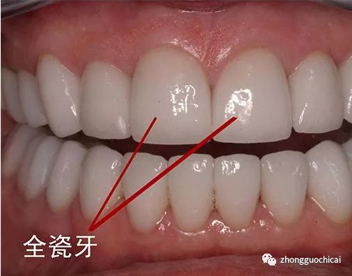 牙齿掉了镶哪种假牙比较好,牙齿缺失多用什么义齿好