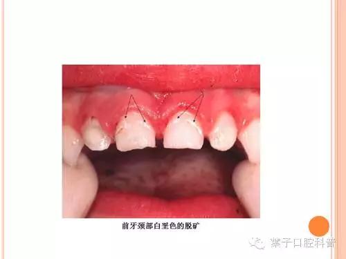 吃什么食物可以预防和修复蛀牙,孩子预防蛀牙新方法也太奇葩了