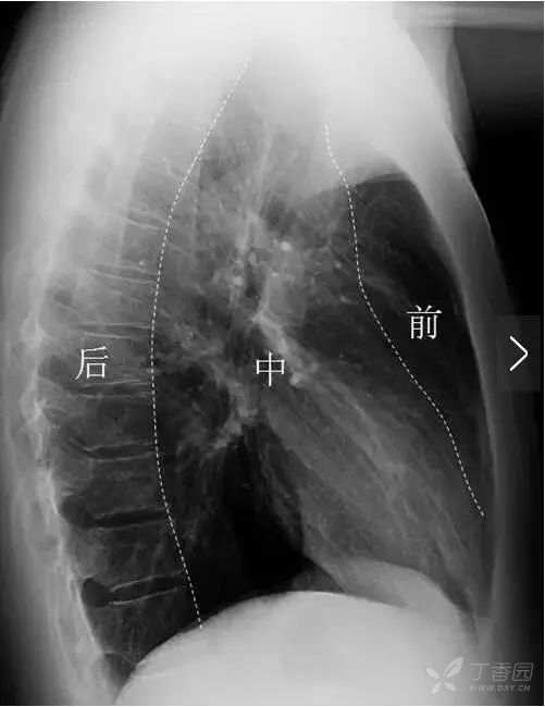 正常胸片图片,正常的胸片讲解