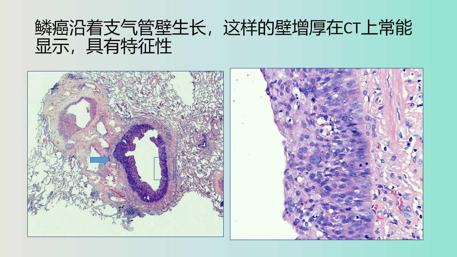 怎样确定肺鳞癌生长速度过快,肺鳞癌肿瘤生长速度