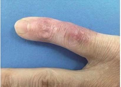 女子被鱼刺卡了喉咙,女子被鱼刺扎破