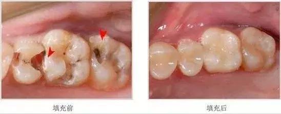 牙齿烂了一半为什么不能补牙,牙齿缺了一半补牙要多少钱