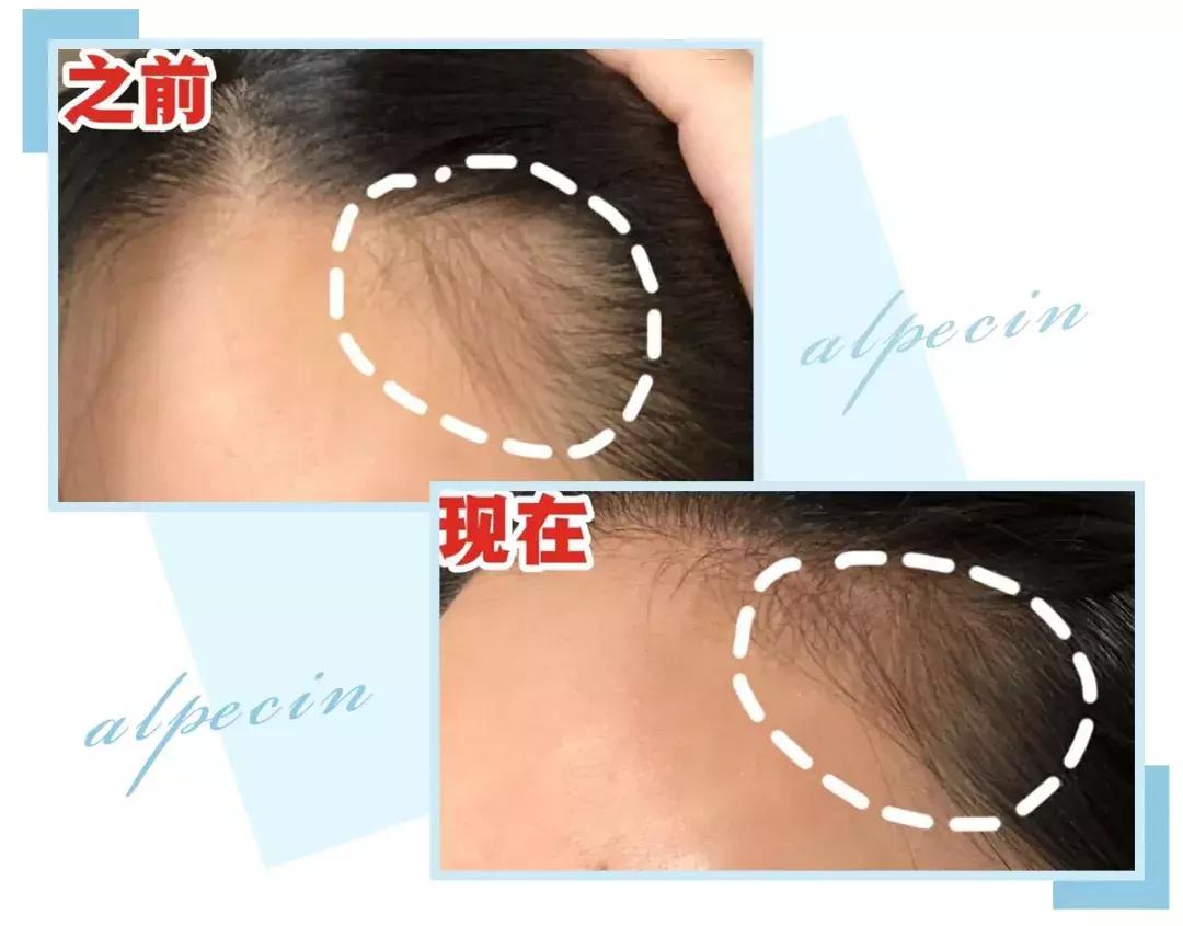 赵丽颖秃头照,赵丽颖秃顶原因