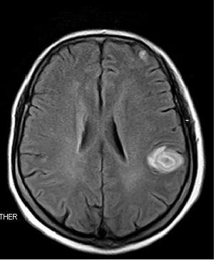 一位肺癌晚期患者活过11年的秘密,极晚期肺癌