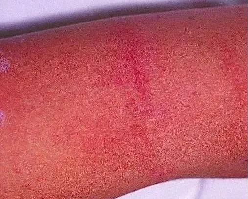 猩红热为什么会全身发热,猩红热和风疹发热的区别