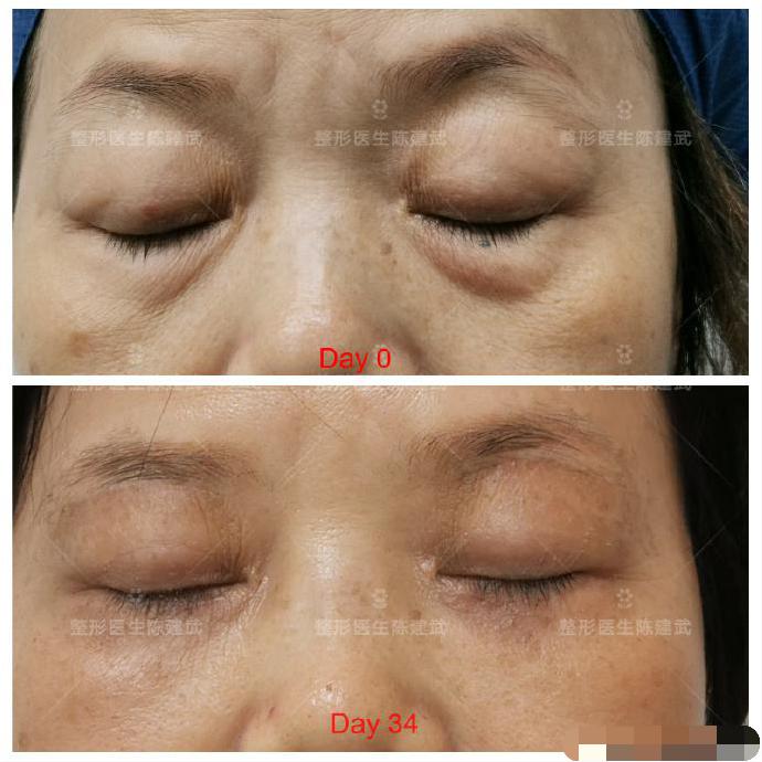 去眼袋泪沟医美方法,想了解一下去眼袋的最佳方法