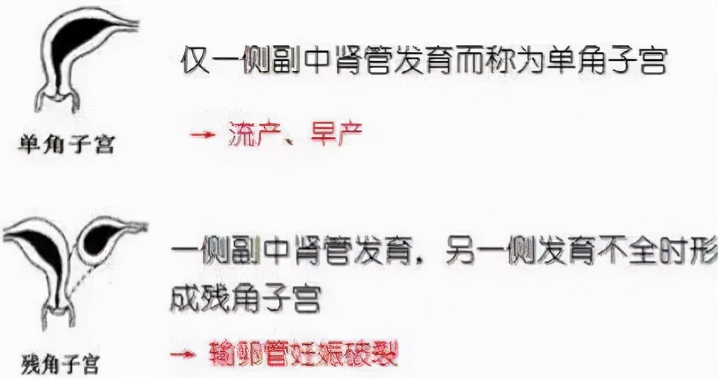 子宫畸形通过健身能改善吗,子宫畸形的最佳治疗方法
