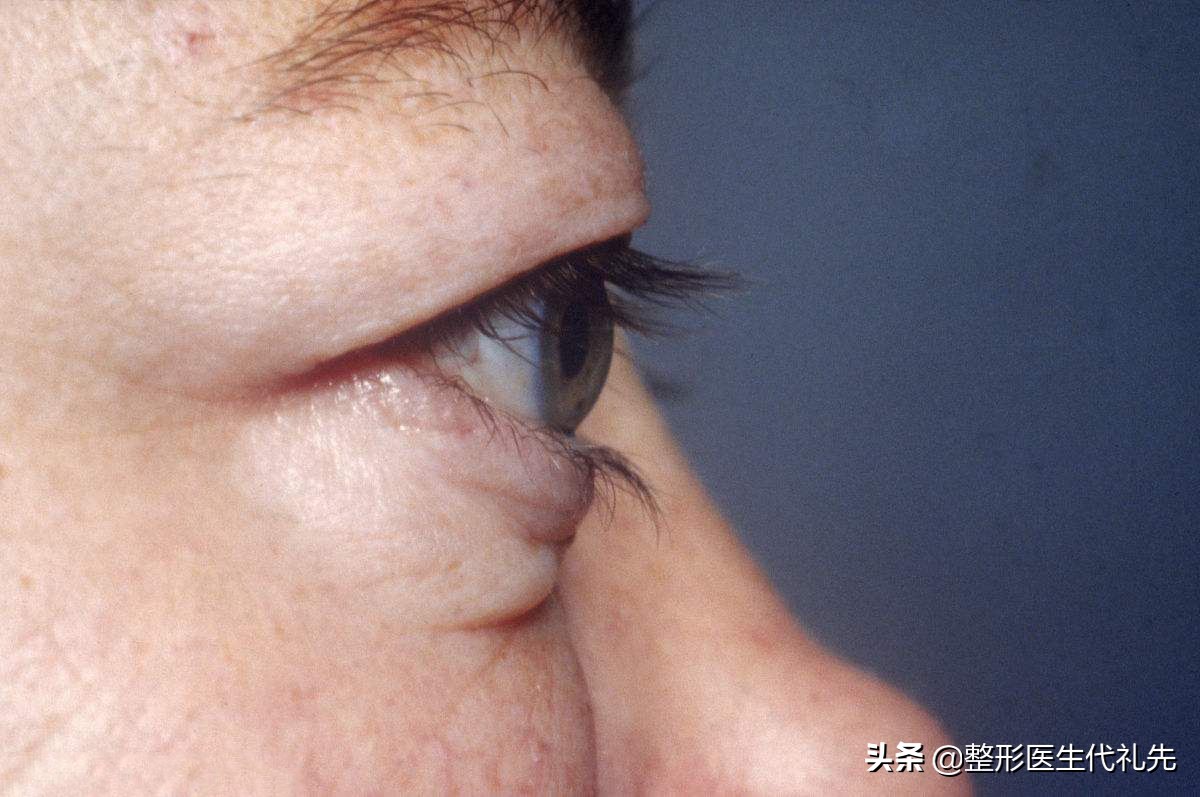 近视凸眼能做双眼皮吗,眼睛凸可以做手术改变吗