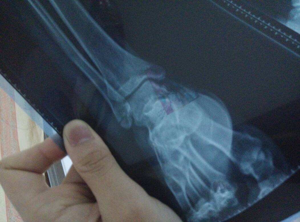 脚崴了踝骨骨折一直疼怎么办,踝关节崴了骨折有什么症状