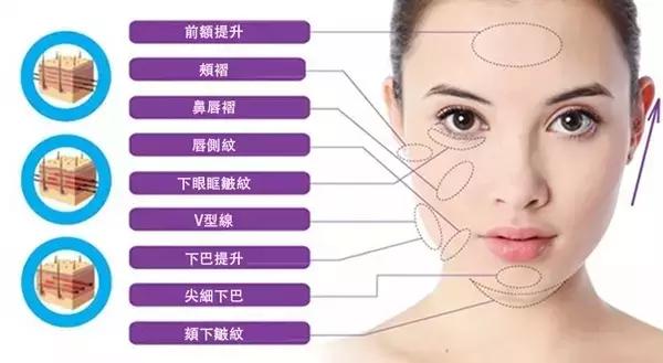 线雕一般多久做一次比较好,线雕多做几次维持的时间会越长吗