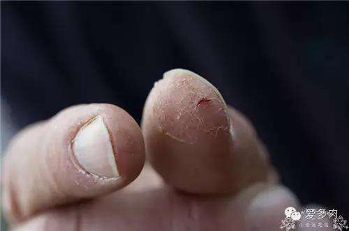 手指每年春天就起泡脱皮怎么治疗,手指起泡脱皮是什么原因
