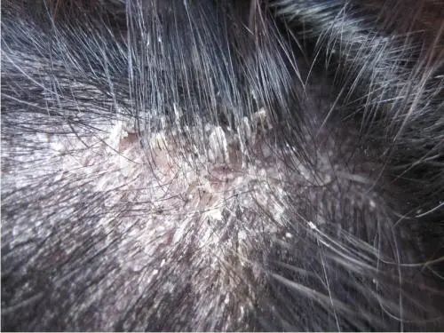 为什么用去屑洗发水头屑越多,为什么头屑洗不掉反而越洗越多