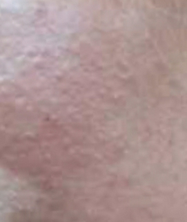 脸和脖子烧灼感,脸过敏烧灼感怎么回事