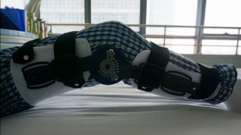 运动损伤的早期处理方案,急性运动损伤最佳治疗方法