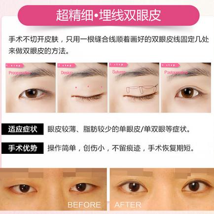 埋线双眼皮术后效果,双眼皮埋线术后消肿日记