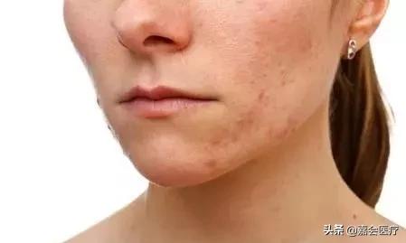 反反复复的痘痘涂什么药膏,反反复复痘痘痘印怎么祛除