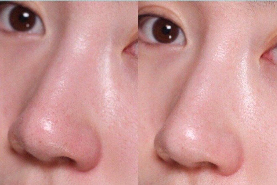 阿娇美容祛黑头,阿娇第一次使用清洁霜