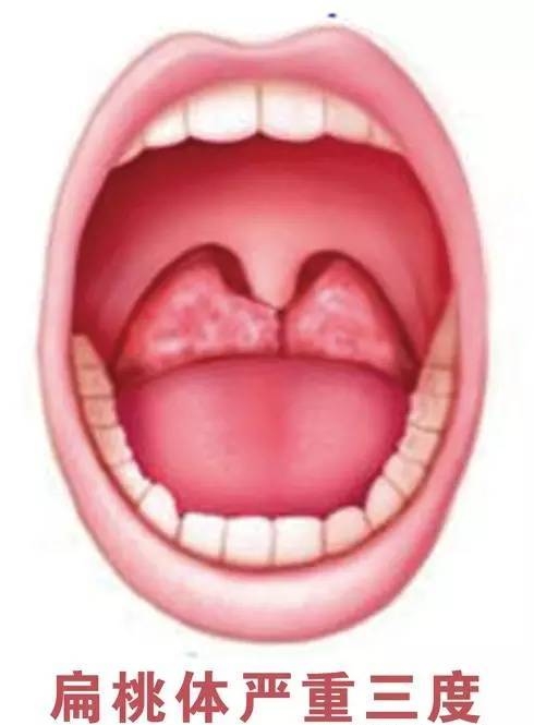 急性化脓性扁桃体炎有多痛,急性扁桃体炎咽部疼痛与什么有关